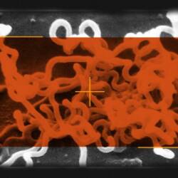 Image of Syphilis a Bacterium called Treponema Pallidum